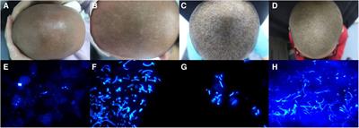 Case Report: Scalp pityriasis versicolor may be a neglected problem